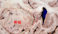 集成学习+遗传算法，基于转录组预测胶质瘤患者生存率的算法套路